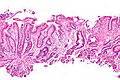 Gastric antral vascular ectasia - Libre Pathology