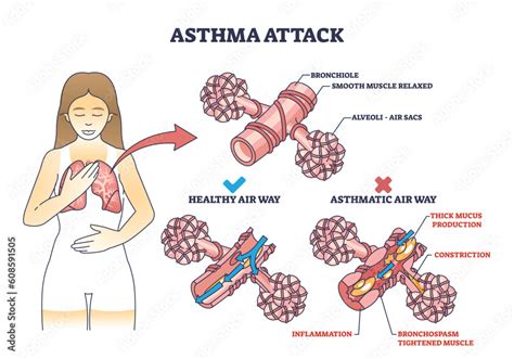 Asthma attack explanation compared with healthy air way outline diagram. Labeled educational ...