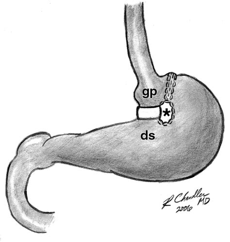 Vertical Banded Gastroplasty Complications