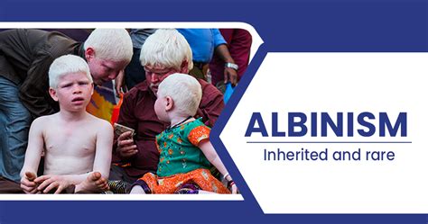 Albinism - Causes, Symptoms and Treatment - Star Health