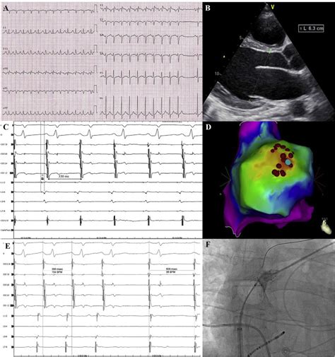 Panel A: Electrocardiogram (ECG) showing a long RP tachycardia at 160... | Download Scientific ...