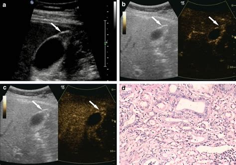 Gallbladder adenomyomatosis. a Ultrasonography (US) showed limited ...