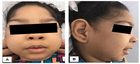 -Facial photographs of a patient with severe microcephaly at 3 years... | Download Scientific ...