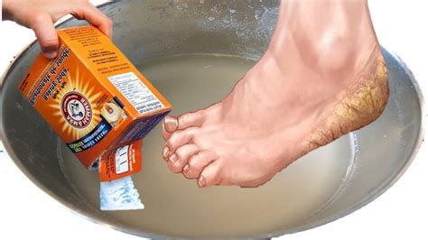 Foot Callus Remover Remedies – Foot Care Tips