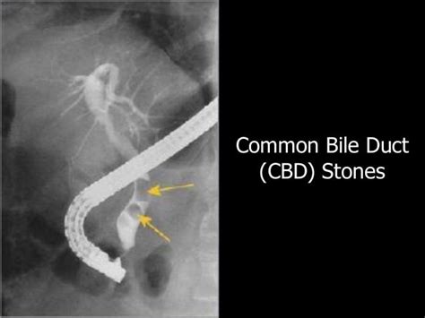 Approach to Common Bile Duct Stones