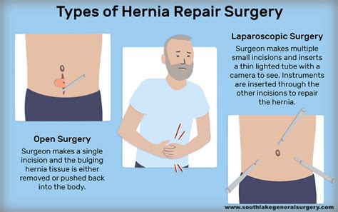 Femoral Hernia