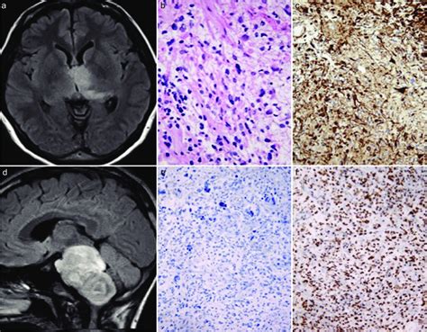 Diffuse midline glioma, H3 K27M-mutant. (a) Axial FLAIR MRI shows an... | Download Scientific ...