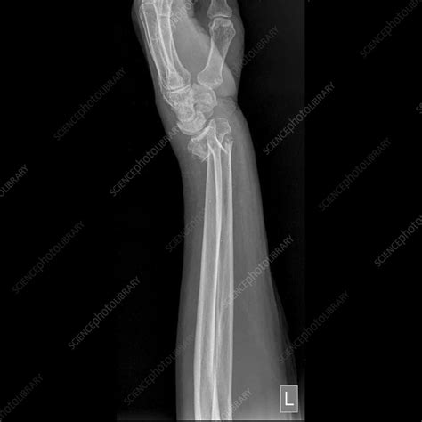 Colles fracture, X-ray - Stock Image - F034/8220 - Science Photo Library