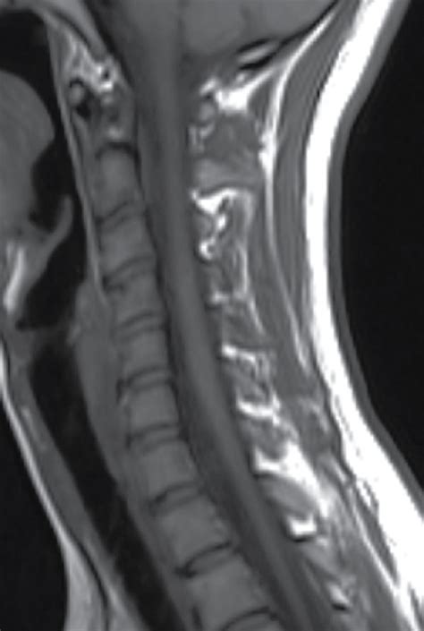 Cervical spinal cord MRI of an MS patient in our center, a 29-year-old ...