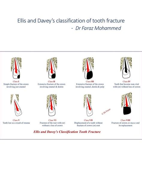 Classification Of Tooth Fracture