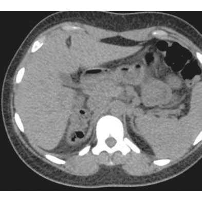 Absent right kidney with compensatory hypertrophy noted in the left ...