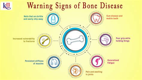 7 Warning Signs of Bone Disease