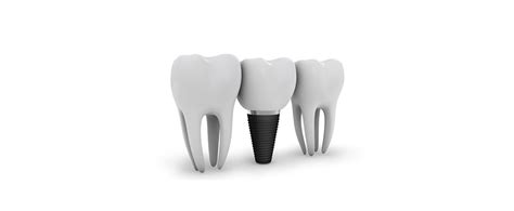 implants – Abby Dental Care