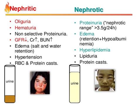 nephrotic and nephritic syndrome - Google Search Doctor Of Nursing ...