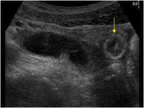 Abdomen and retroperitoneum | 1.6 Gastrointestinal tract : Case 1.6.7 ...