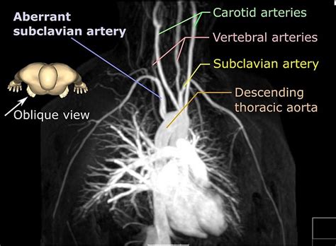 Subclavian Artery - The Definitive Guide | Biology Dictionary