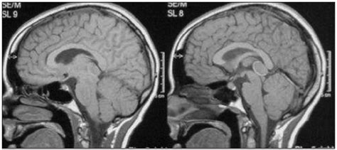 The microsurgical management of benign pineal cysts: Helsinki ...