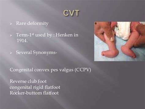 Congenital vertical talus