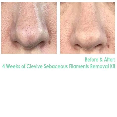 The Sebaceous Filaments Removal Kit – Clevive