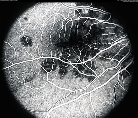 APMPPE, Fluorescein Angiography - Retina Image Bank