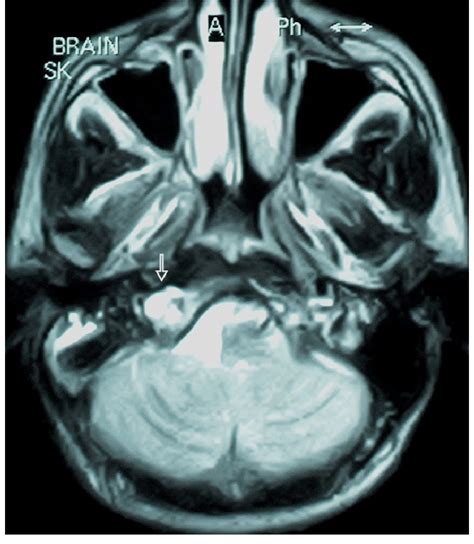 T2-weighted axial MRI showing a large hyperintense lesion with no... | Download Scientific Diagram