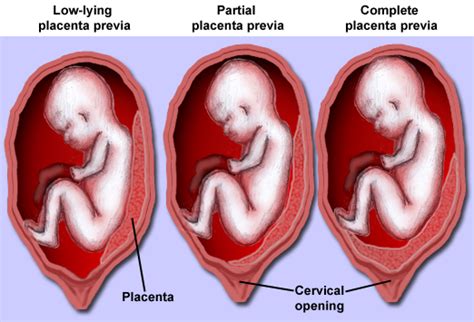 What is Placenta Previa? Definition, Symptoms, Causes, and Treatment