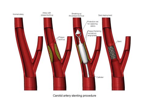 Carotid Artery Stenting Procedure Diorama - 3D Print Model by RachidSW