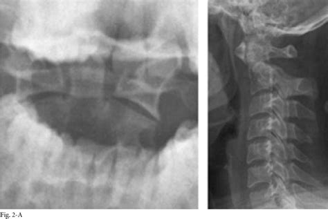 Figure 1 from Reliability and reproducibility of dens fracture ...