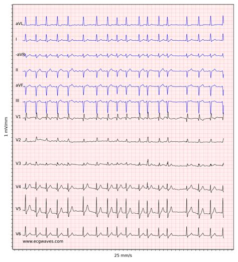 Atrial fibrillation: ECG, classification, causes, risk factors ...