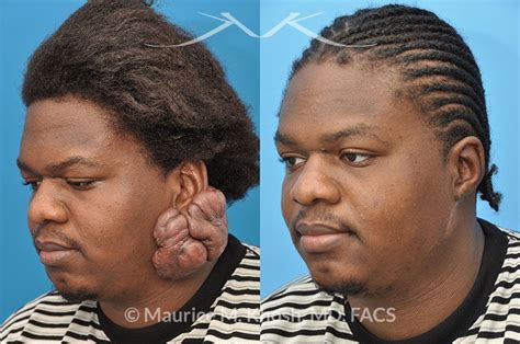 New York Facial Plastic Surgery Keloid Scar Reconstruction Before and After Pictures