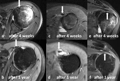 MRI reveals a progressive pulley and PASTA lesion after 1 year. White... | Download Scientific ...