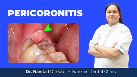 What is Pericoronitis ? How does it occur?, How is it treated? I Home remedies for Pericoronitis ...