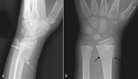 Impacted Fracture X Ray