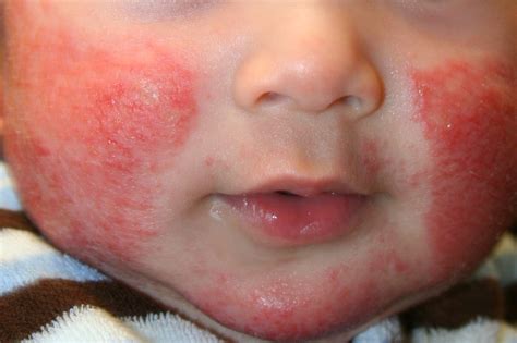 Atopic Dermatitis or Eczema, contact dermatitis natural treatment