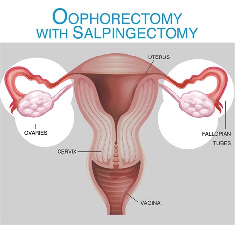 Hysterectomy - Oophorectomy