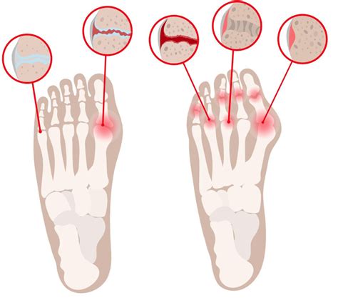 What are the first signs of arthritis in the toes? - Newman Feet