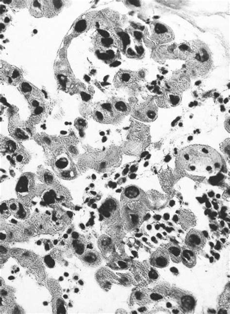 Pathology Outlines - Radiation atypia