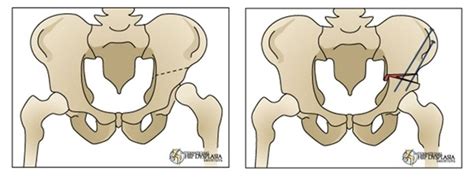 Osteotomy - International Hip Dysplasia Institute