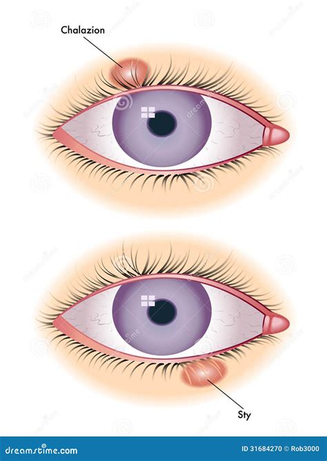 Chalazion & sty stock vector. Illustration of disease - 31684270