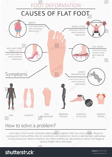 Foot Deformation Medical Desease Infographic Causes Stock Vector (Royalty Free) 793721074