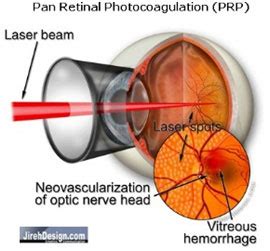 Argon Laser Treatment | PRP Retinal Laser - Kenia Eye Hospital