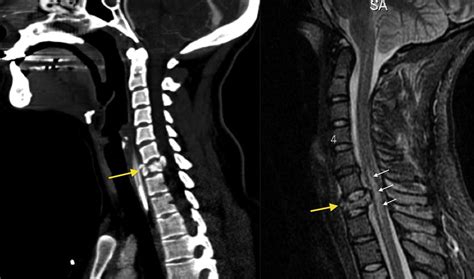 Cervical burst fracture - Radiology at St. Vincent's University Hospital