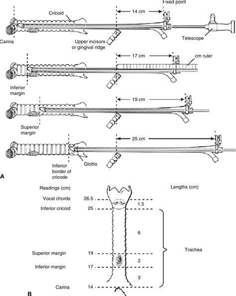 Rigid Bronchoscopy: Indications and Techniques - Operative Techniques ...