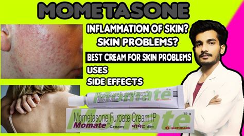 Momate Cream Use in Hindi | Mometasone furoate cream | Side Effects ...