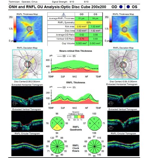 Identifying Normal Tension Glaucoma Requires Diligent Clinical ...