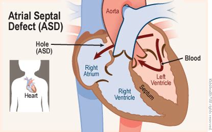 Atrial Septal Defect (ASD) (for Parents) | Nemours KidsHealth