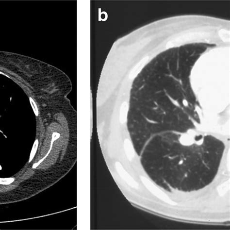 Lung perfusion scan in CTEPH, showing homogeneous ventilation and... | Download Scientific Diagram