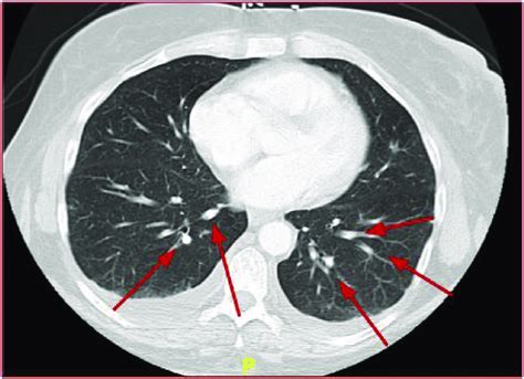 Pulmonary Septic Emboli seen on CT Chest. | Download Scientific Diagram