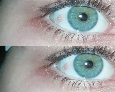 Pimple on eyeball after (stupidly) wearing old contact, where to get help? UK : r/optometry