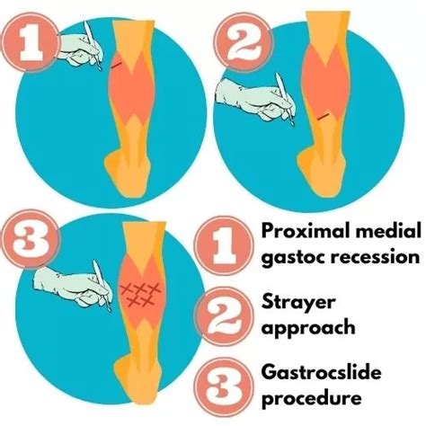 Comprehensive Guide to Plantar Fasciitis Surgery